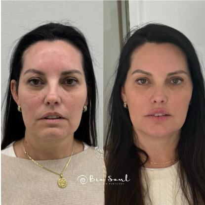 Foto da capa de Estetica Bio Soul | Harmonização Facial | Mogi das Cruzes